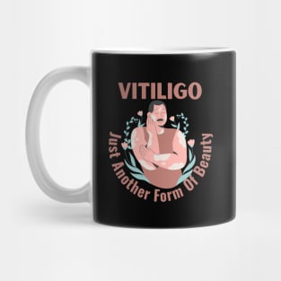 Vitiligo Just Another Form Of Beauty Male Model Mug